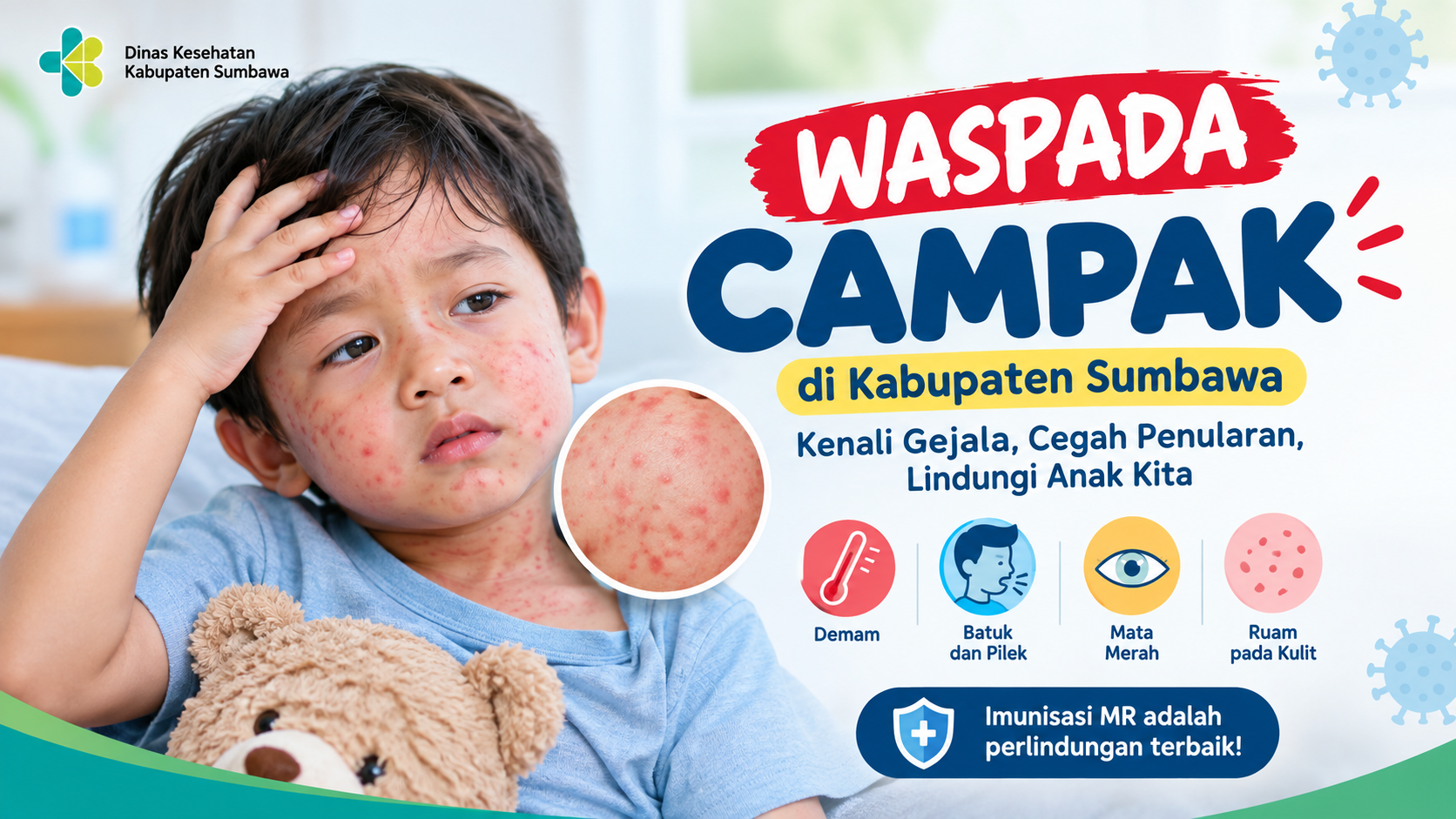 Waspada Campak di Kabupaten Sumbawa, Kenali Gejala dan Cara Mencegah Penularannya